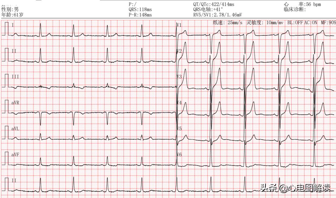 t型波异常什么意思,t波改变类型