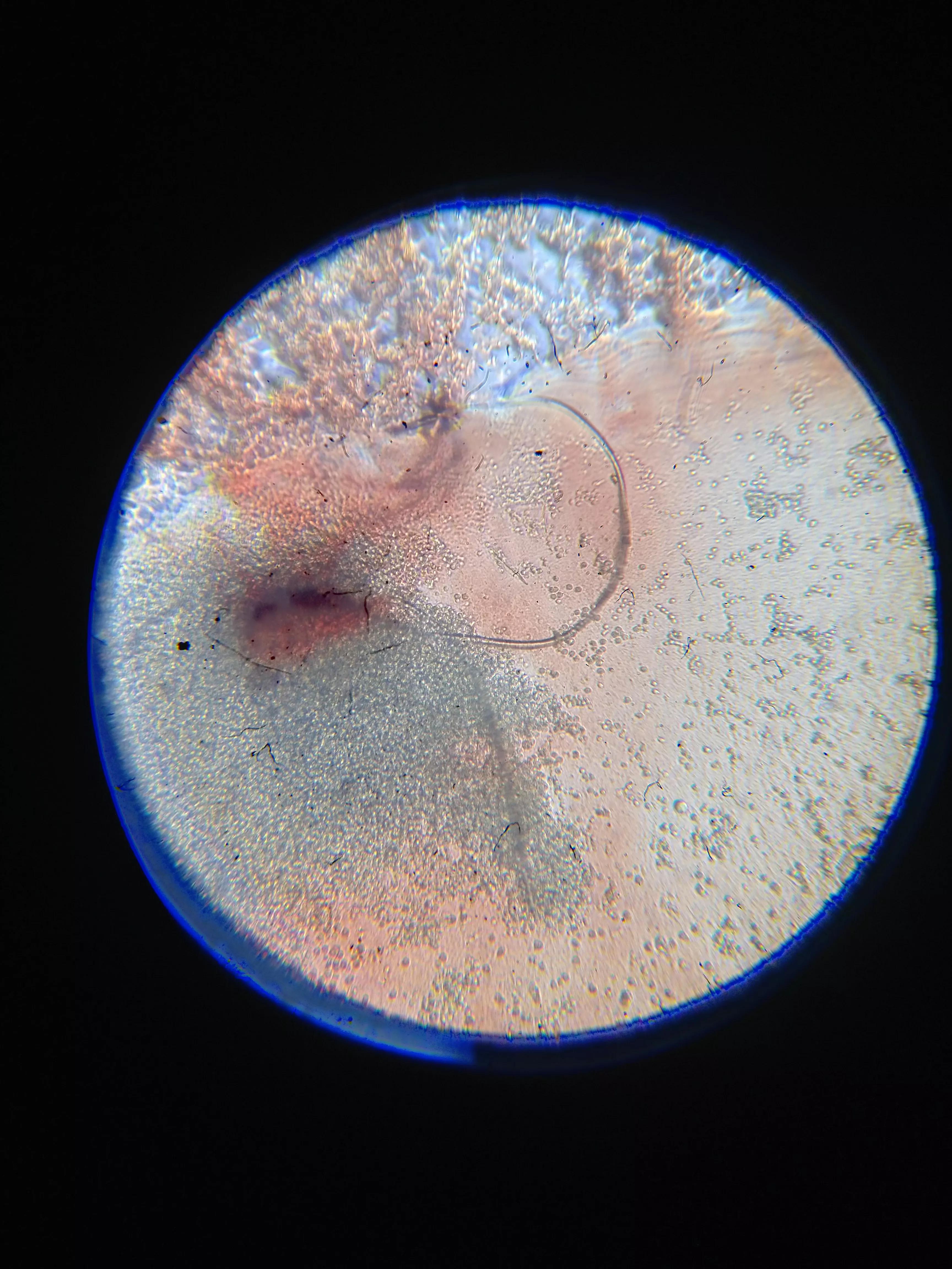 牛皮癣伴随一生是怎么样的体验,对抗牛皮癣一直在坚持