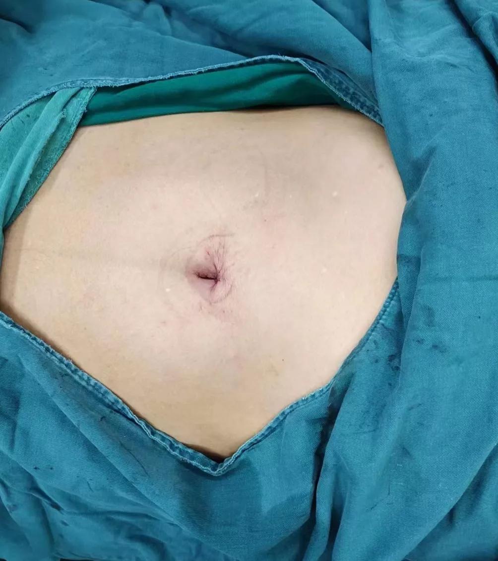 微创跟单孔腹腔镜的区别,微创腹腔镜单孔取胆结石