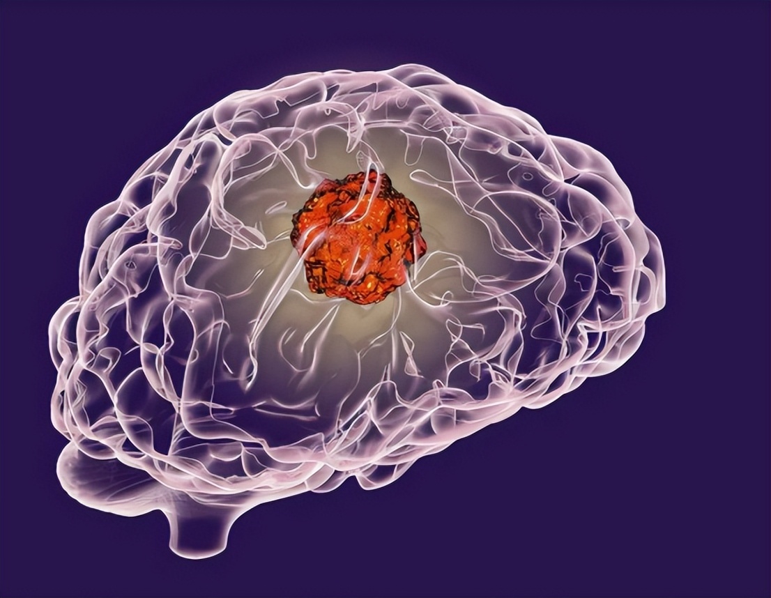 民间土方治疗脑中风,脑中风是什么原因和征兆