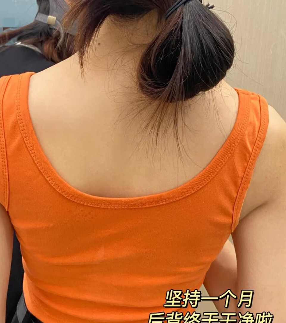 一分钟消除脓包痘,清除脓包型痘痘实操