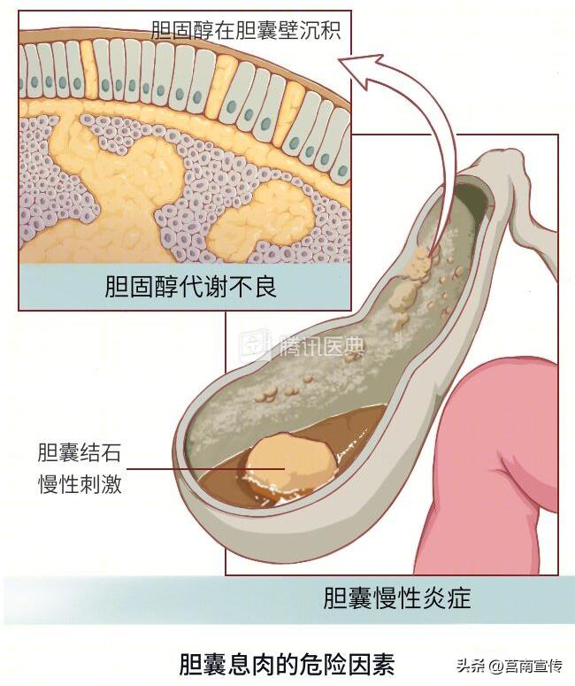 发现息肉，离癌有多远？