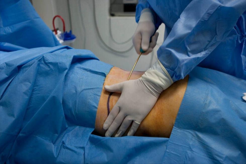 想吸脂减肥一定要了解这些知识,想减肥如何抽脂