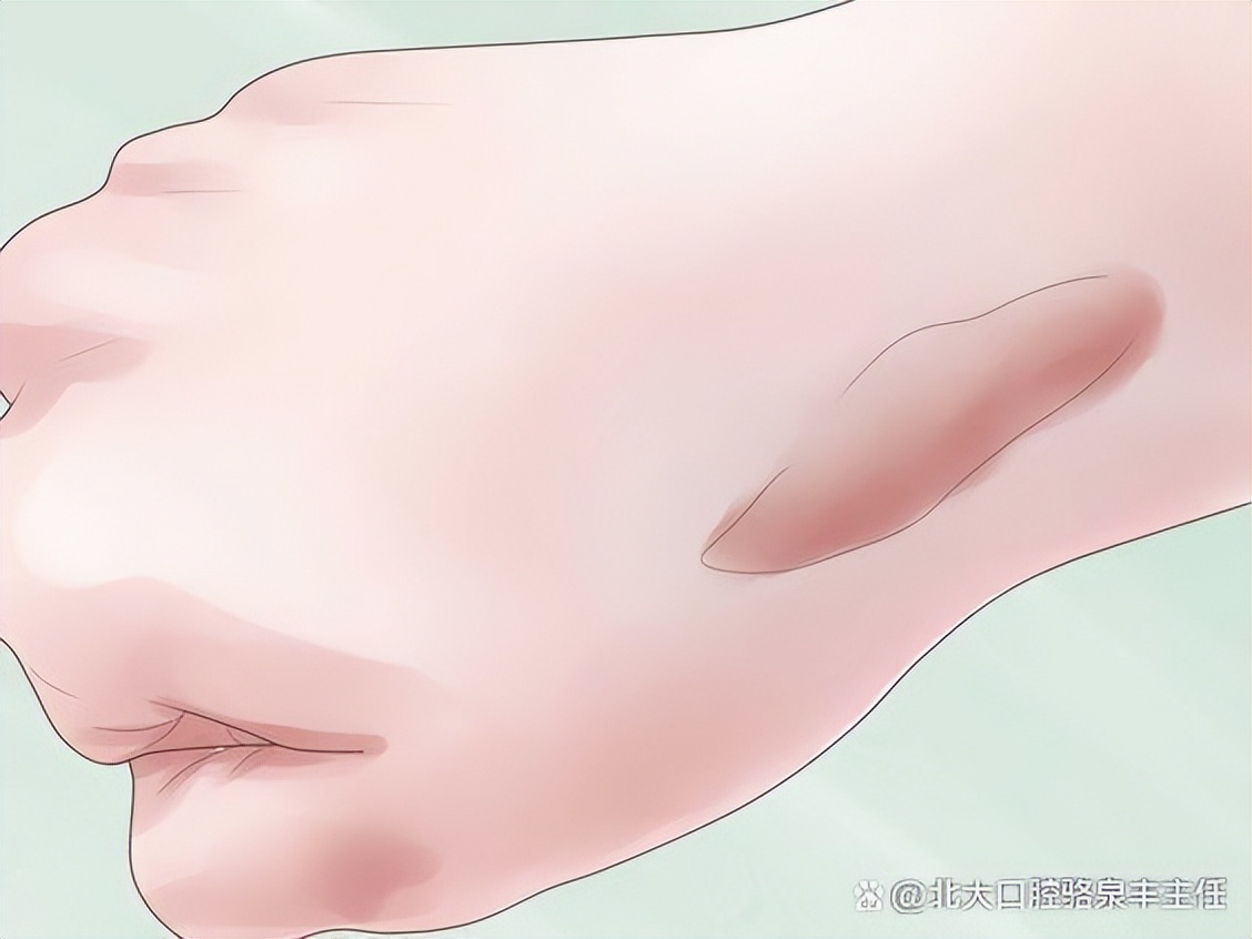 祛疤贴正确的方法,疤痕贴怎么祛疤