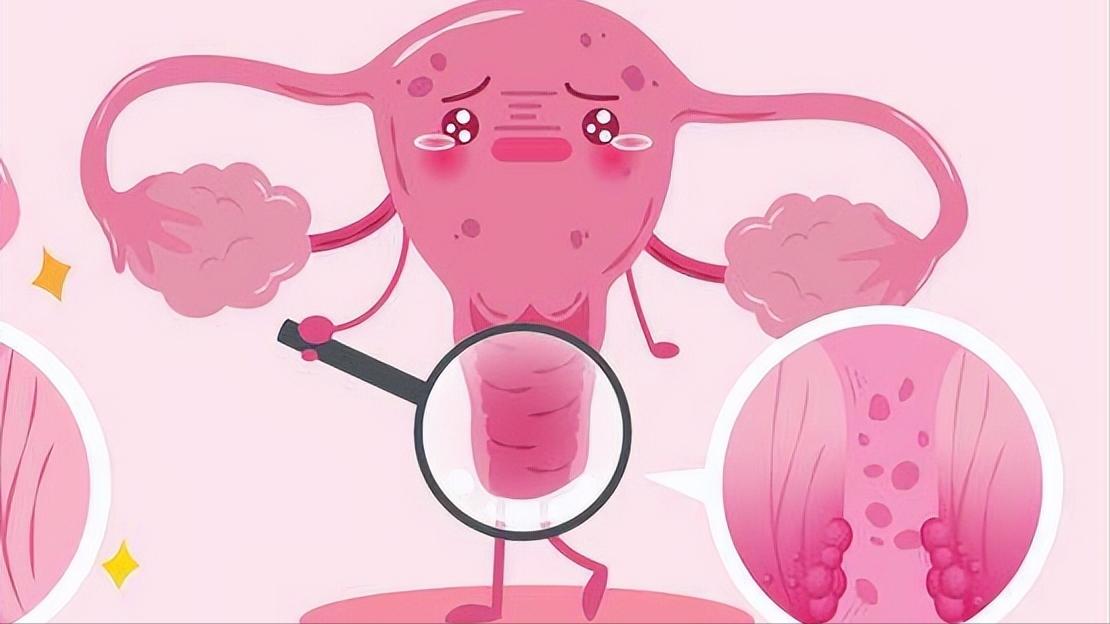 看到腺肌症,40岁女士顿悟了,终于明白自己为何例假痛得直打滚了