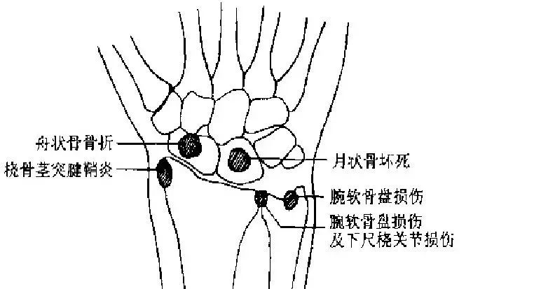 常见运动损伤及处理方法教案,体育课常见运动损伤及处理