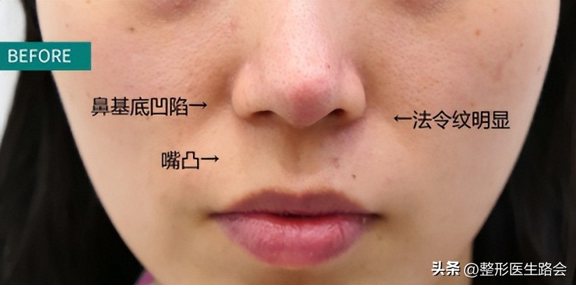 年龄大面部塌陷,年龄大皮肤松弛怎么办