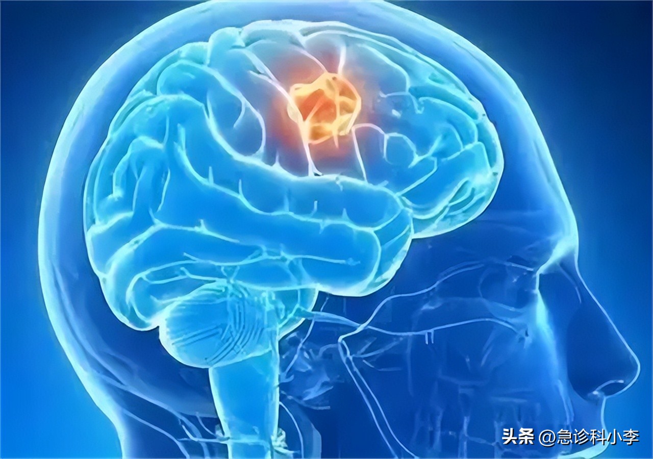 儿童得了脑胶质瘤最多活几年,脑胶质瘤患者的真实就医经历