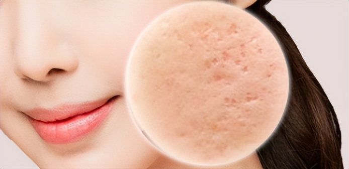 痘痘是怎么引起的如何有效祛痘,痘痘反复长你知道如何正确祛痘吗