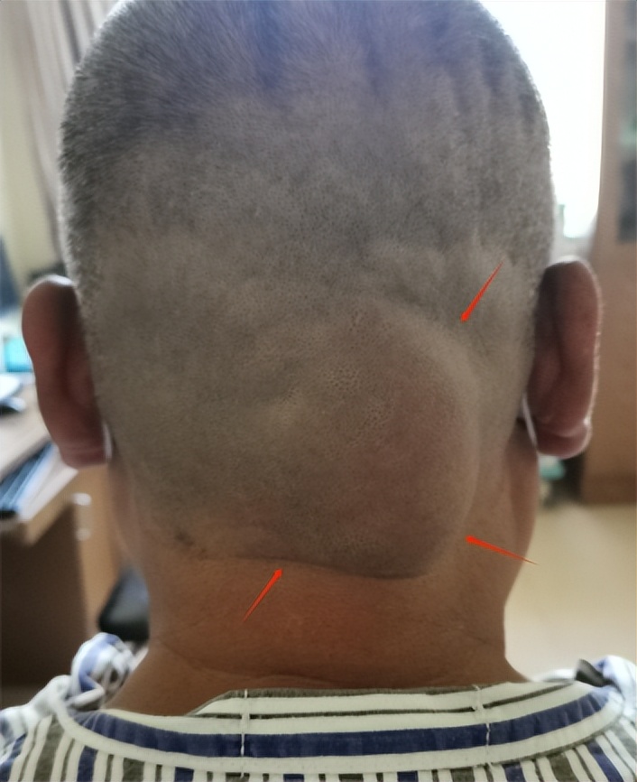 神经外科切除头皮脂肪瘤,脂肪瘤外科门诊手术