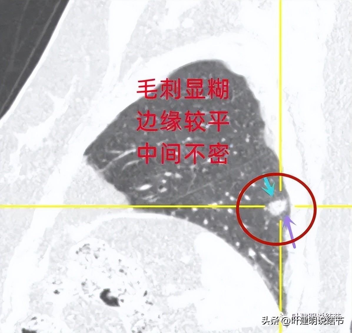 肺结节实性为什么建议抗炎治疗,肺上实性结节抗炎后变成空洞