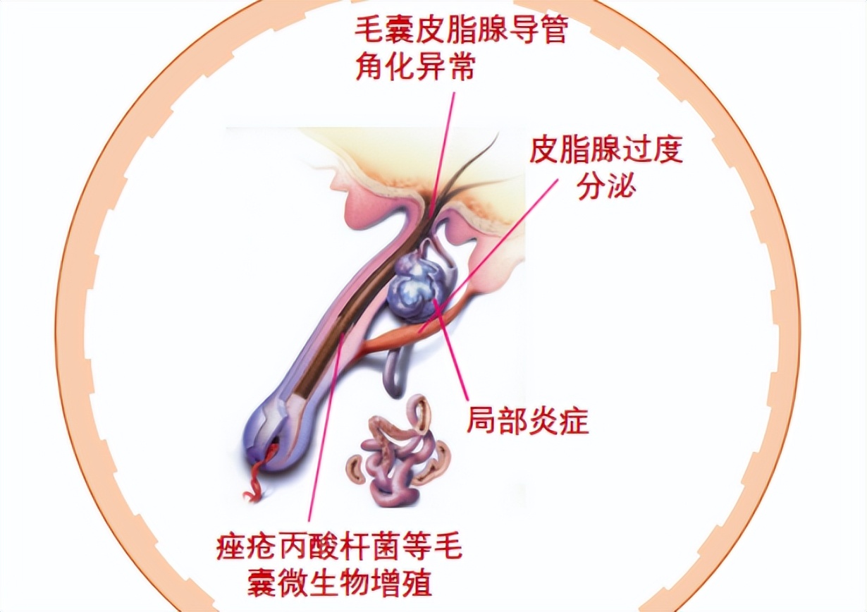 痘痘反复长痘印消不掉怎么办,3到4年青春痘反反复复用什么药好