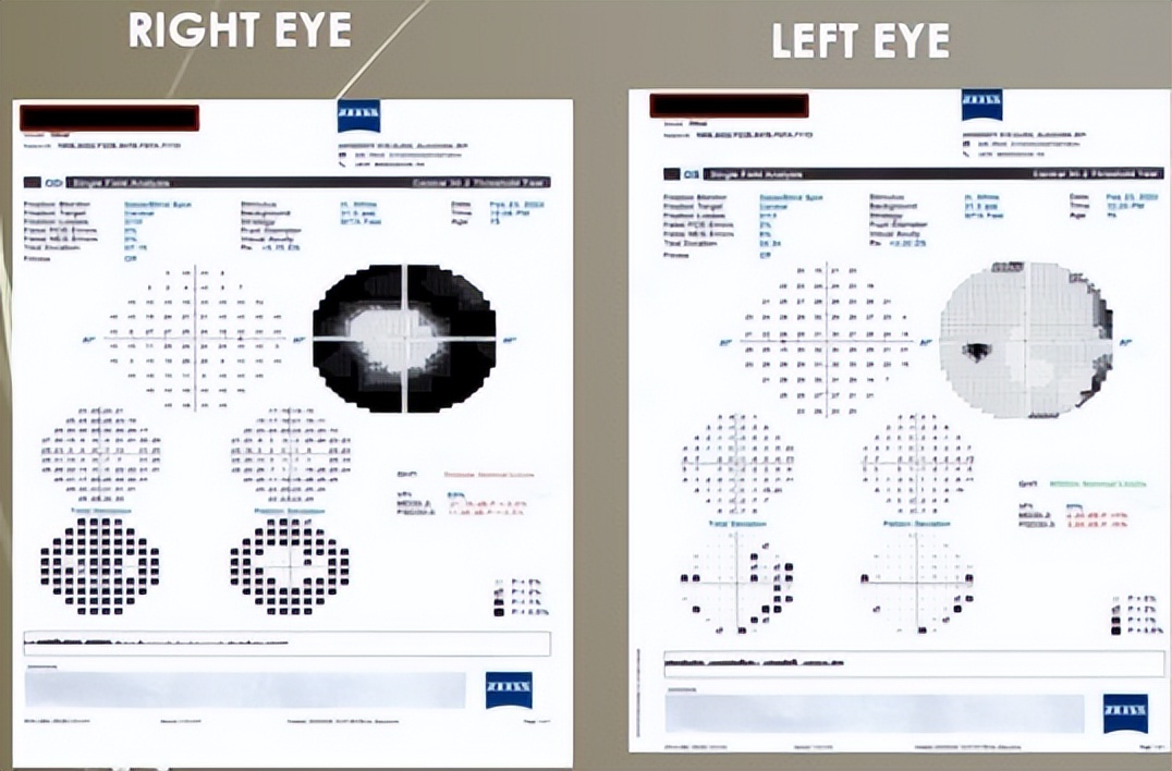 视网膜炎oct的详细图解,视网膜色素变性oct检查