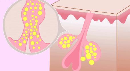下巴反反复复有痘痘,脸上起痘痘反反复复
