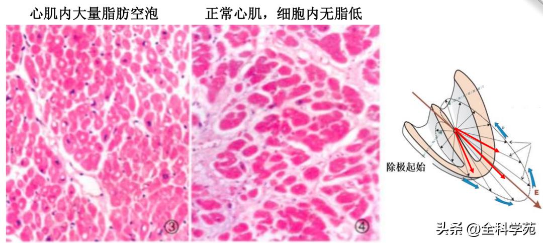 心电图qrs时限超宽是什么引起的,心电图qrs波呈m型见于什么疾病