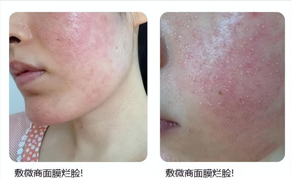 脸泛红是洗面奶的原因吗,为什么用完洗面奶脸会变白