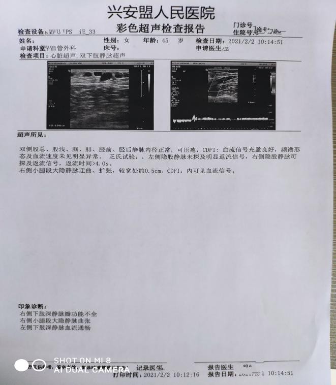 大隐静脉曲张并血栓形成处理方法,大隐静脉曲张的十大危害