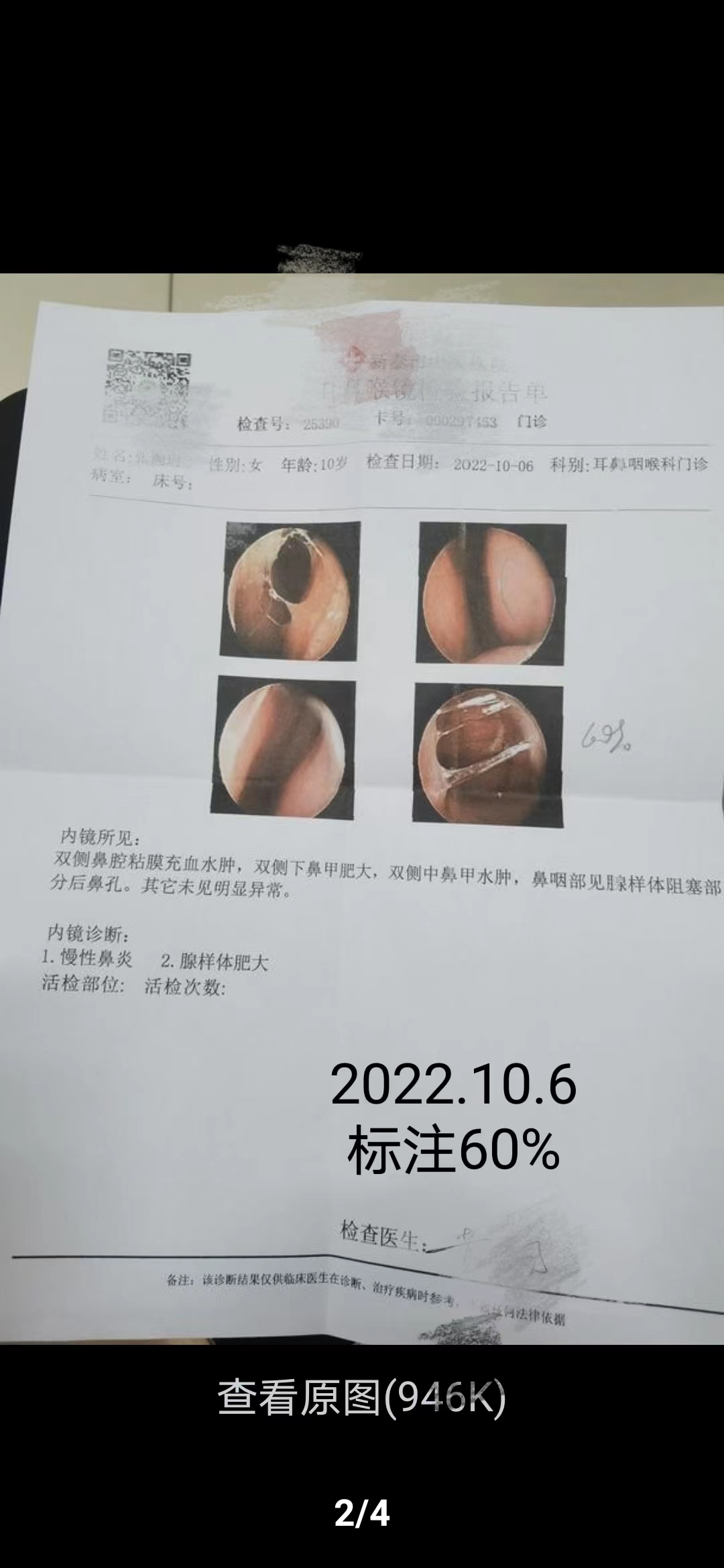孩子鼻炎腺样体肥大中医怎样调理,腺样体肥大是看中医好还是西医好