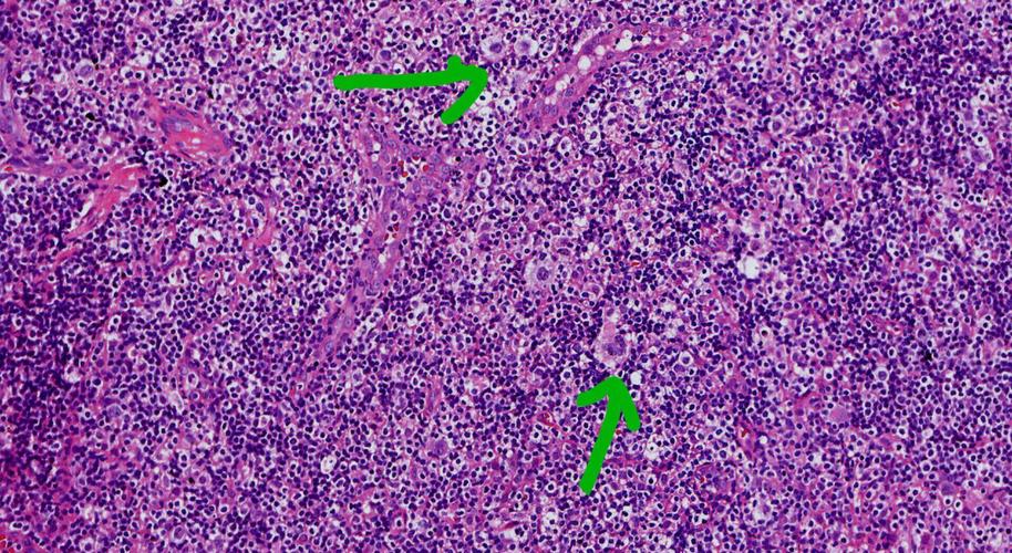 【科普】子宫内膜癌有两种类型，你了解吗？腹腔镜手术效果如何？