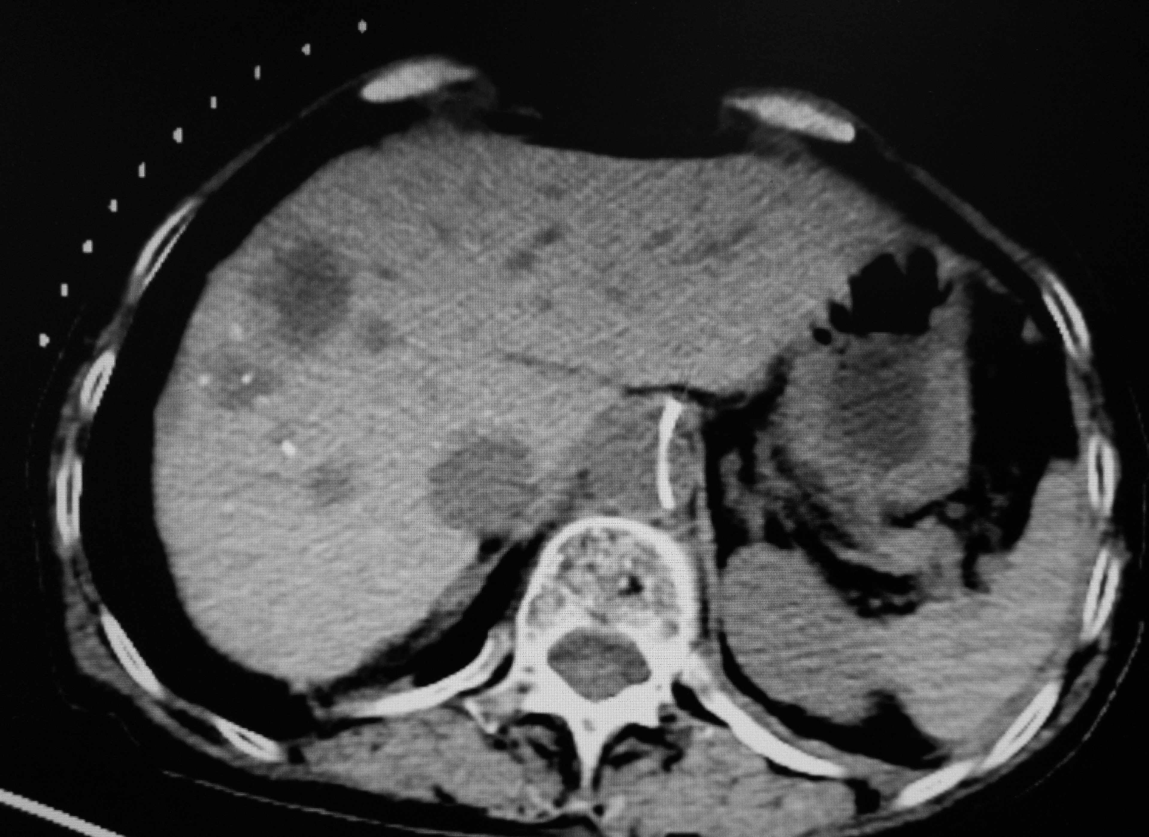 肠癌肝转移先做化疗还是介入,肠癌肝转移介入治疗哪里做得好
