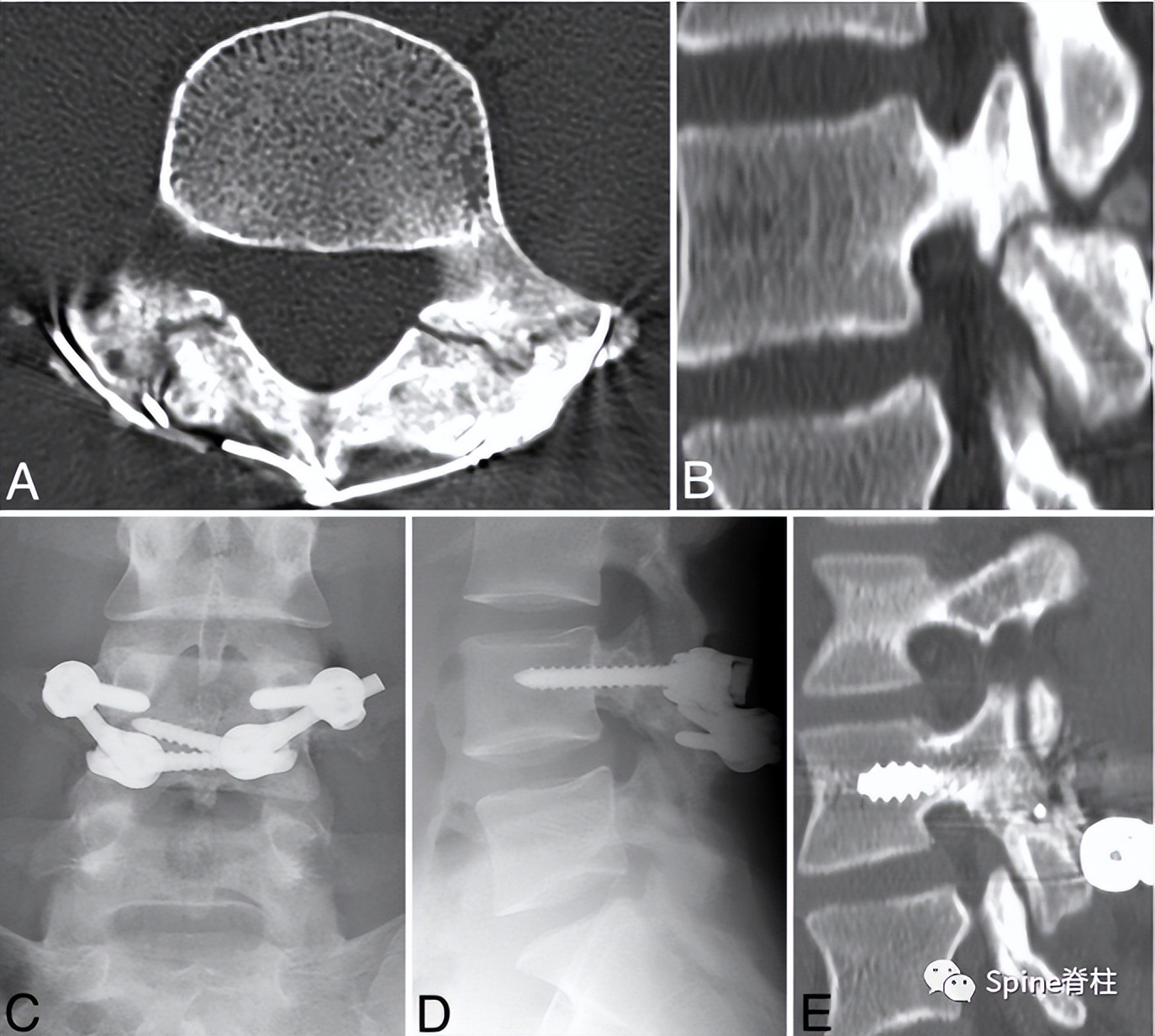轻度峡部裂和重度峡部裂的区别,真性峡部裂和假性峡部裂