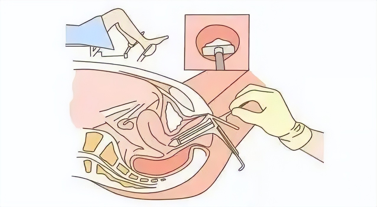 女性预防妇科病的防护措施,呵护女性健康