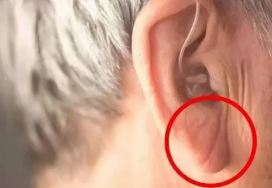 耳垂有折痕会得心梗吗,耳垂上有褶皱就是心脏病前兆吗
