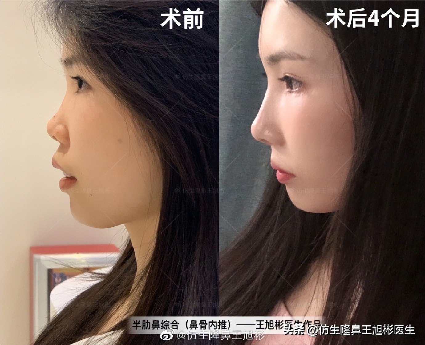 鼻基底填充会移位到鼻孔吗,鼻基底填充假体会拉长人中吗