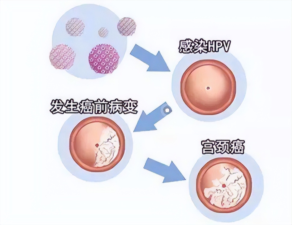 感染了hpv一定会变为癌症吗,感染了hpv一定会得宫颈癌吗