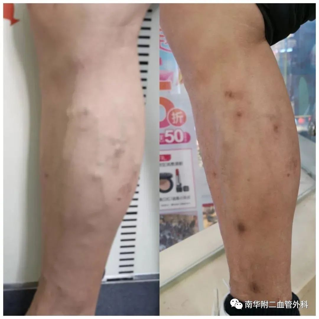 chiva治疗精索静脉曲张,chiva治疗静脉曲张武汉有吗