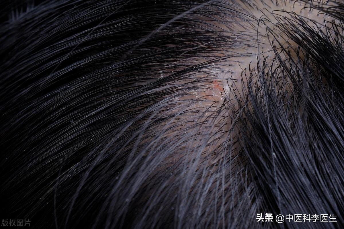头皮和脸上起疙瘩有脓包怎么回事,头皮上长红疙瘩脓包头皮屑特别多