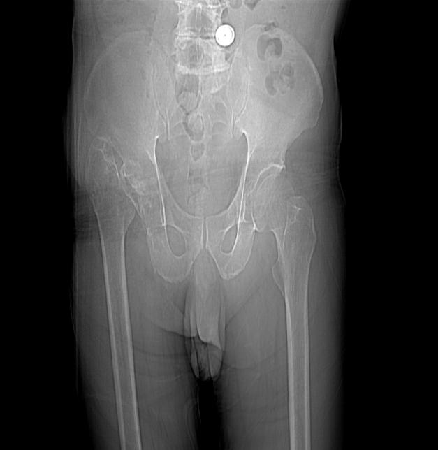 阿尔茨海默症后期摔倒,阿尔茨海默症骨折