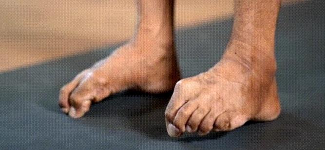 专家支招爱美女士，别让“水晶鞋”内的双脚受伤了