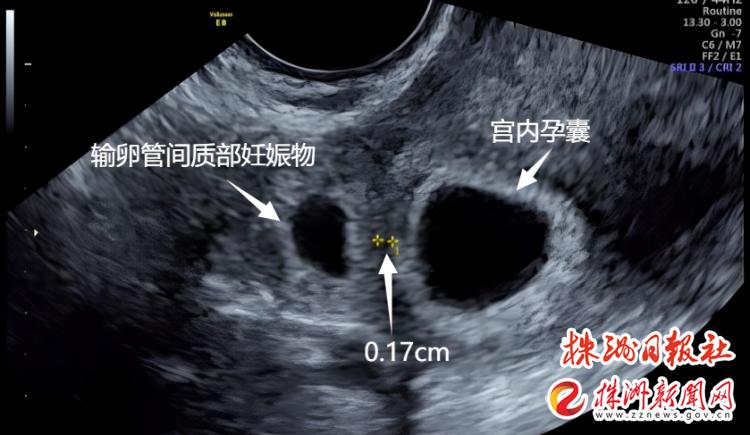 意外怀孕惊喜,意外怀孕的惊吓
