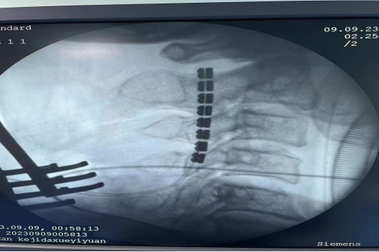 脊髓电刺激成功唤醒多名植物人,脊髓电刺激疗法成功唤醒植物人