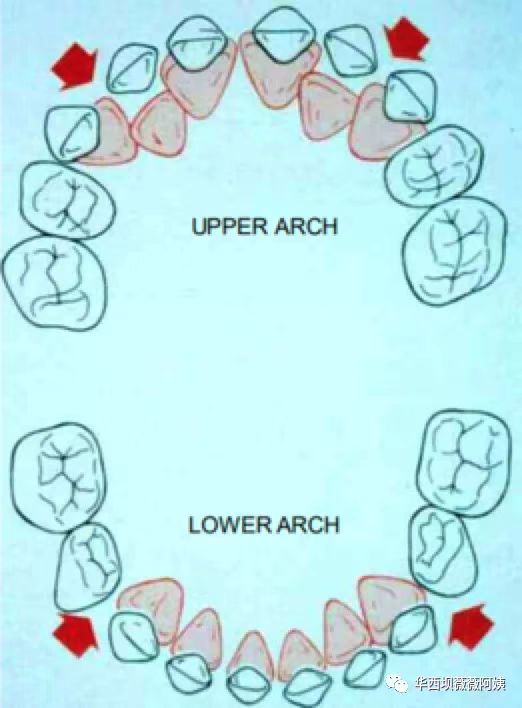 儿童早期牙齿矫正华西,华西口腔小孩矫正牙齿是什么科