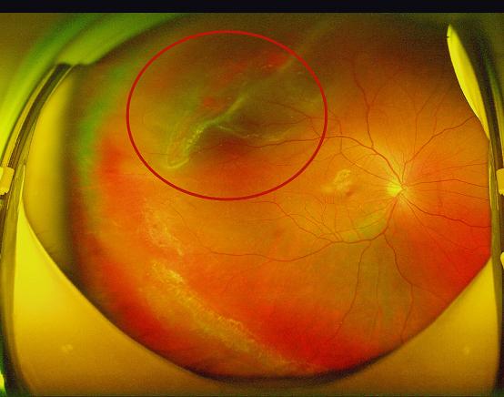 小伙打球致“网脱”*安泰**爱尔眼科医生提醒：高度近视者不宜剧烈运动