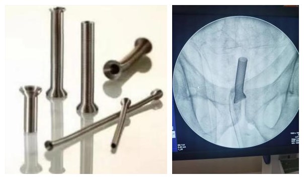 兰大二院泌尿外科完成西部地区首例新型热膨胀镍钛记忆合金金属前列腺支架置入术