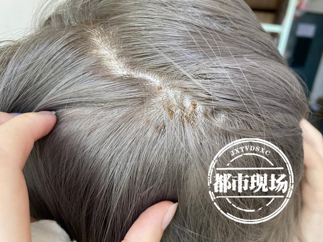 女子染发致坏死,南昌染发出血