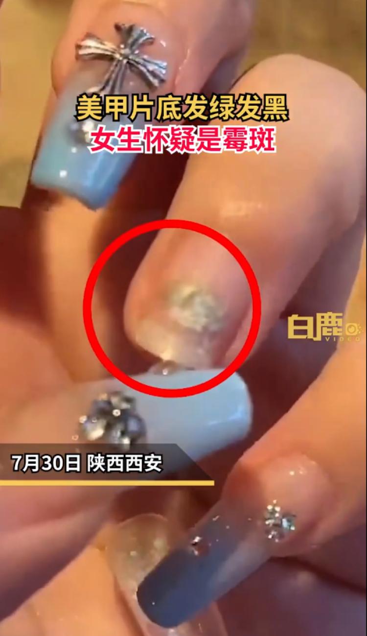 吓人！女生美甲片底发绿发黑疑长霉斑，医生：穿戴甲贴合度不高，会导致铜绿假单胞菌感染