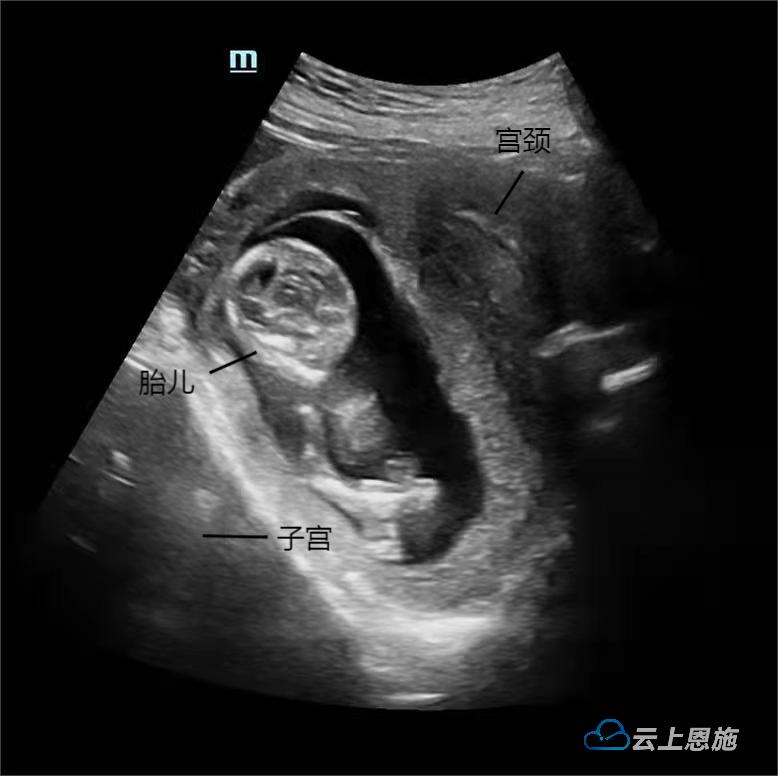 孕妇突发排尿困难恩施州中心医院产科专家：警惕“子宫箝闭”