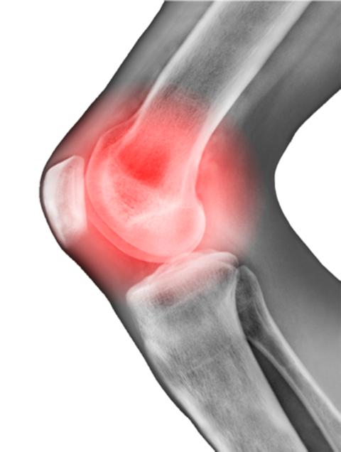 膝关节骨性关节炎的国际顶级治疗,骨性关节炎的物理治疗阶段