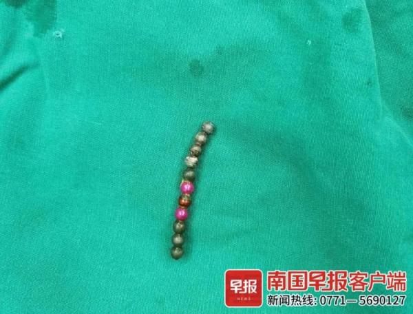 2岁男童误食3颗磁力珠险开腹,5岁男童误吞磁力珠取出来近1米