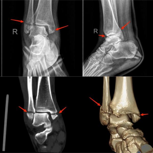 运动损伤知识科普宣传内容,关于足球运动损伤调查问卷