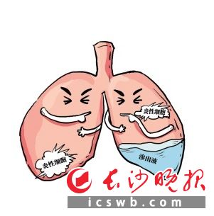 普通咳嗽和肺炎ct有啥区别,不发烧不咳嗽ct查出肺炎