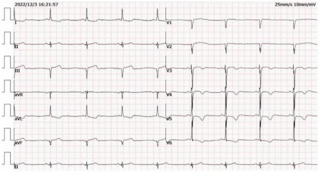 3DF打印助力温州医科大温州医科大学附属第一医院周浩团队完成一例复杂高危的冠脉CTO手术