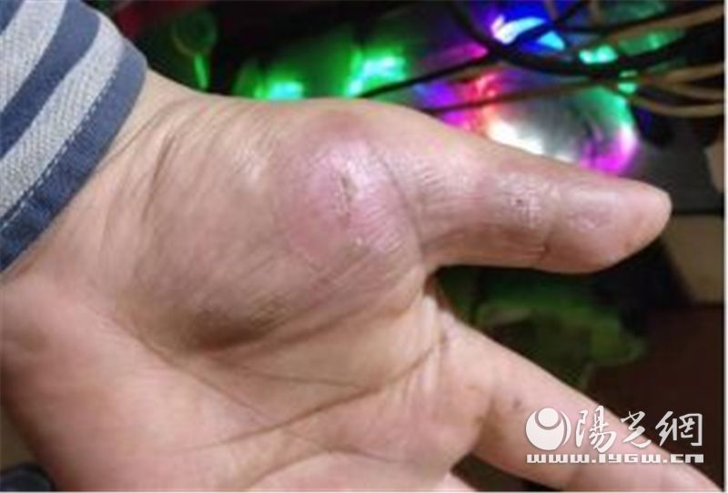 实验室强酸烧伤,化学实验室酸烧伤