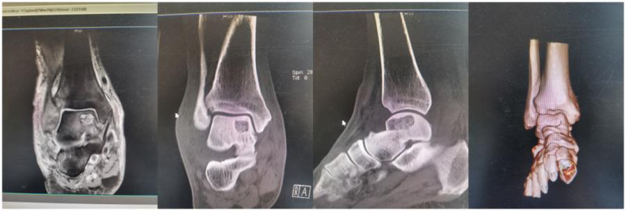 扭伤脚踝五十多天了走路就肿,踝关节扭伤半年后突然疼痛
