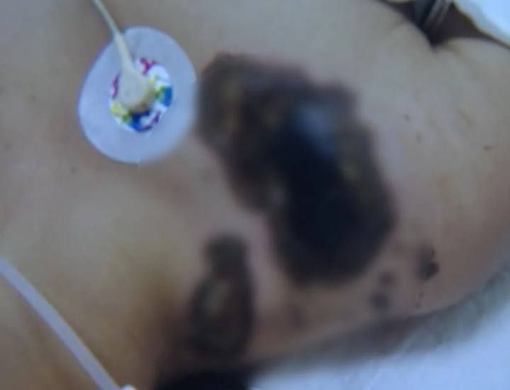 女孩给iphone充电遭电击致内脏受损,女孩充电时玩手机被电击面临截肢