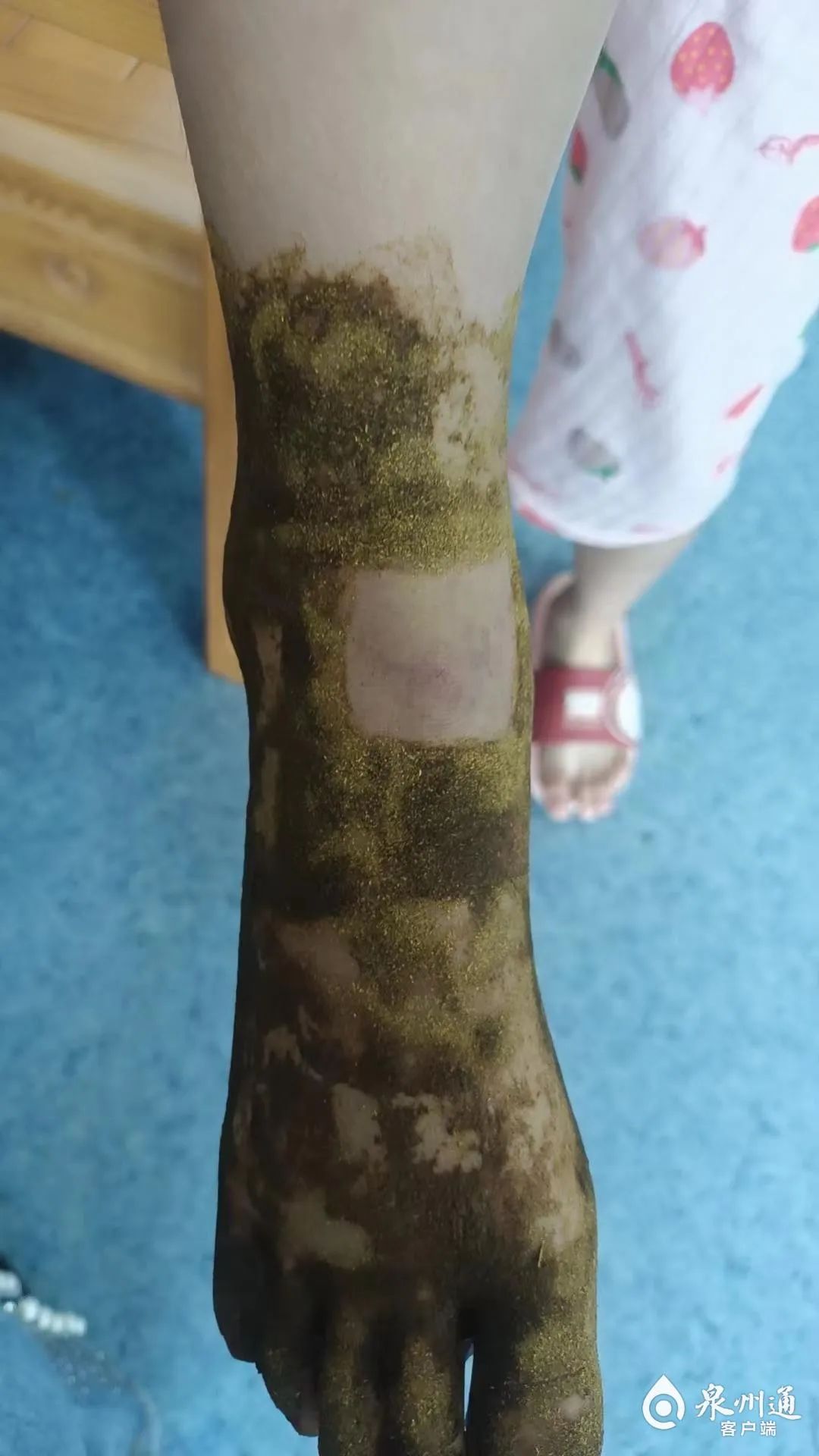 21岁女孩被蛇咬伤,女孩被蛇咬出血